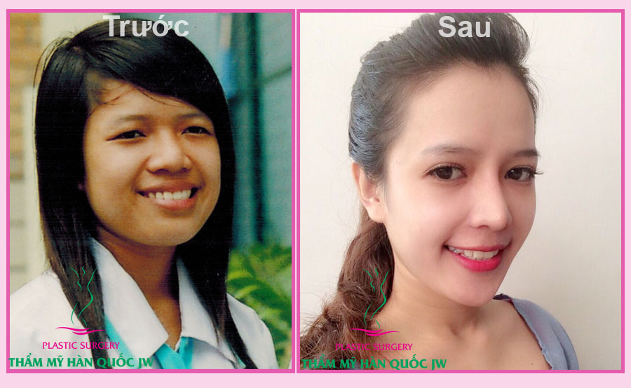Khách hàng của Thẩm mỹ Hàn quốc JW trước và sau khi đến thẩm mỹ.