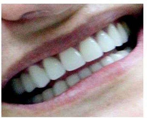 Răng sau khi điều trị.