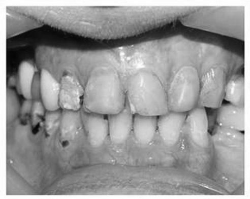 Răng trước khi điều trị.