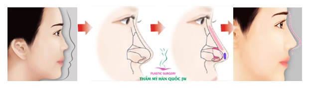Quy trình tạo mũi Sline.