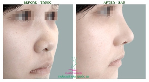 Dễ dàng nhận thấy sự khác biệt hoàn toàn trước và sau khi làm mũi Sline.