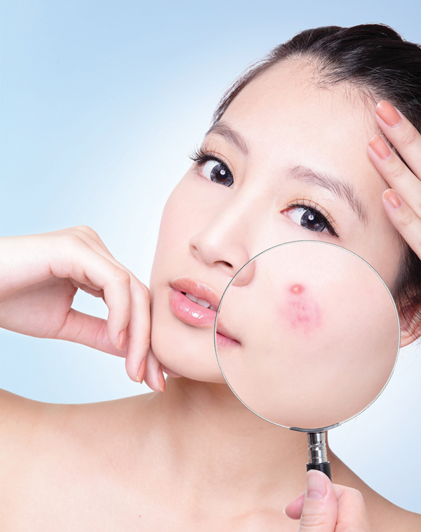 Mụn luôn là nỗi lo lắng của rất nhiều người, đặc biệt là các bạn trẻ.