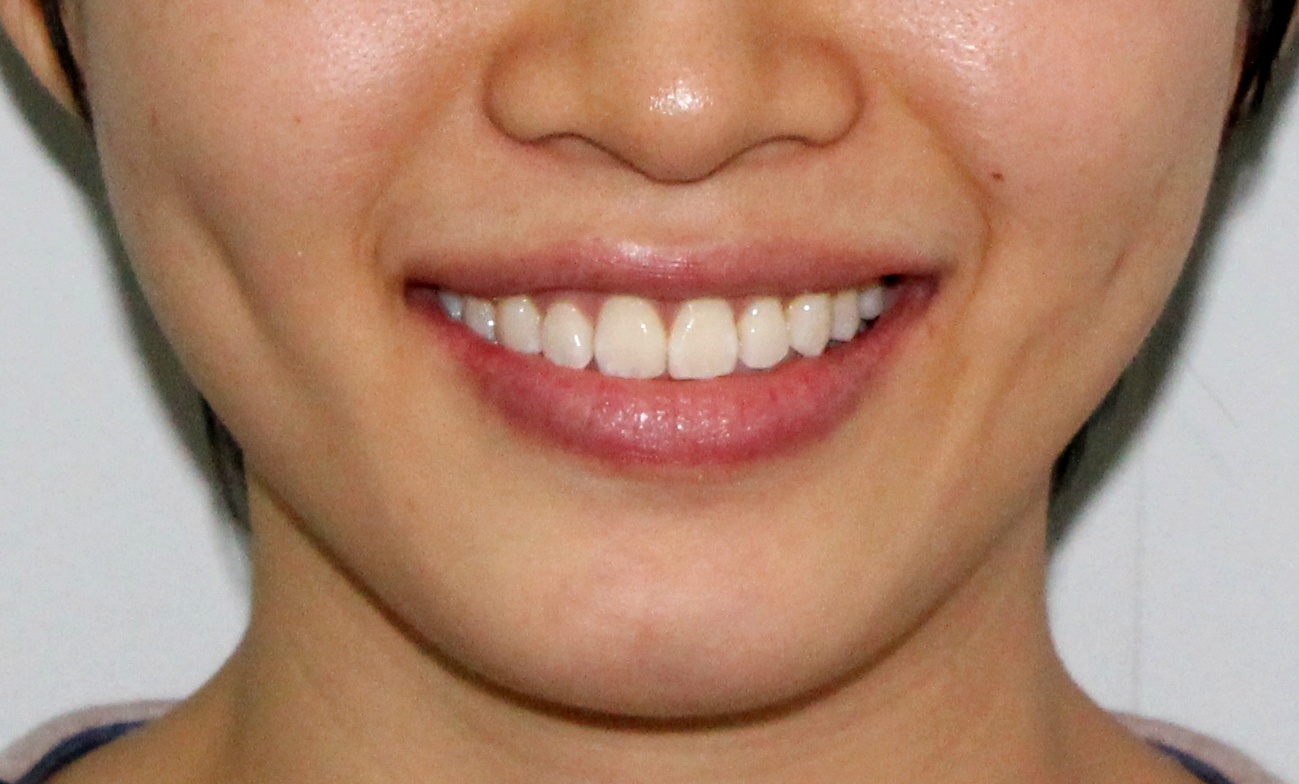 Kết quả sau khi niềng răng.