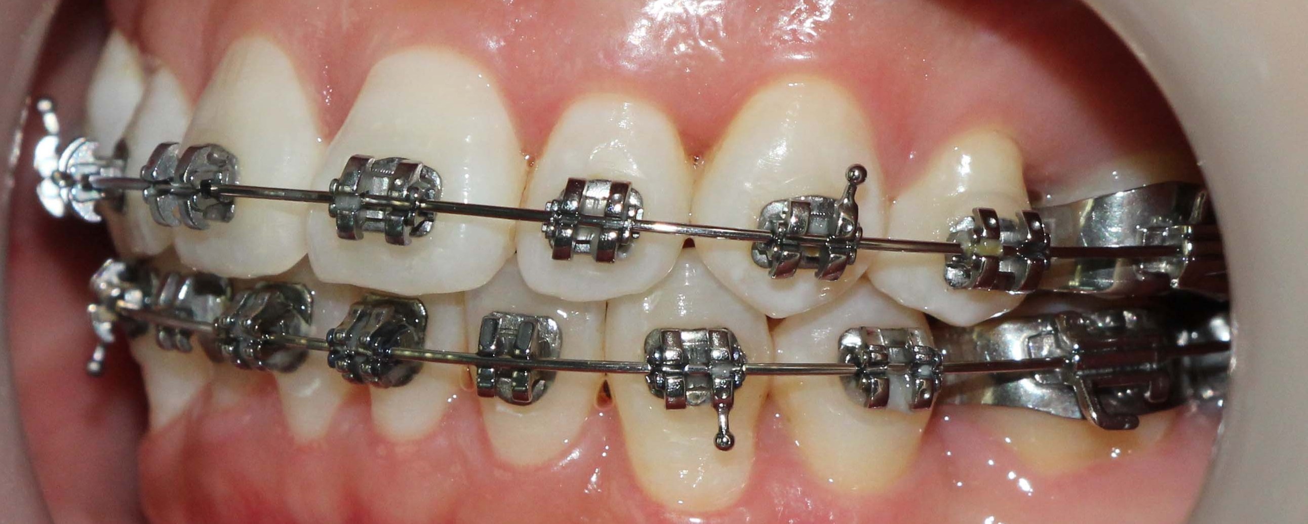 Đang điều trị bằng niềng răng.