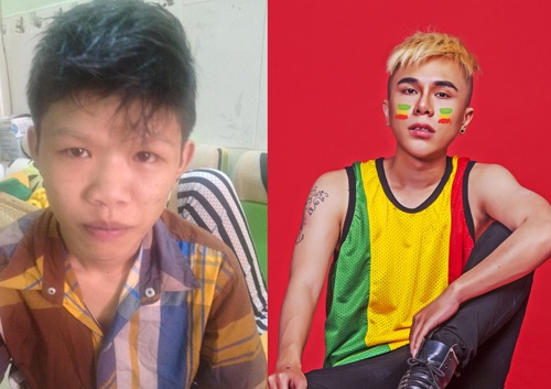 Hình ảnh Đức Kulz trước và sau khi phẫu thuật thẩm mỹ.