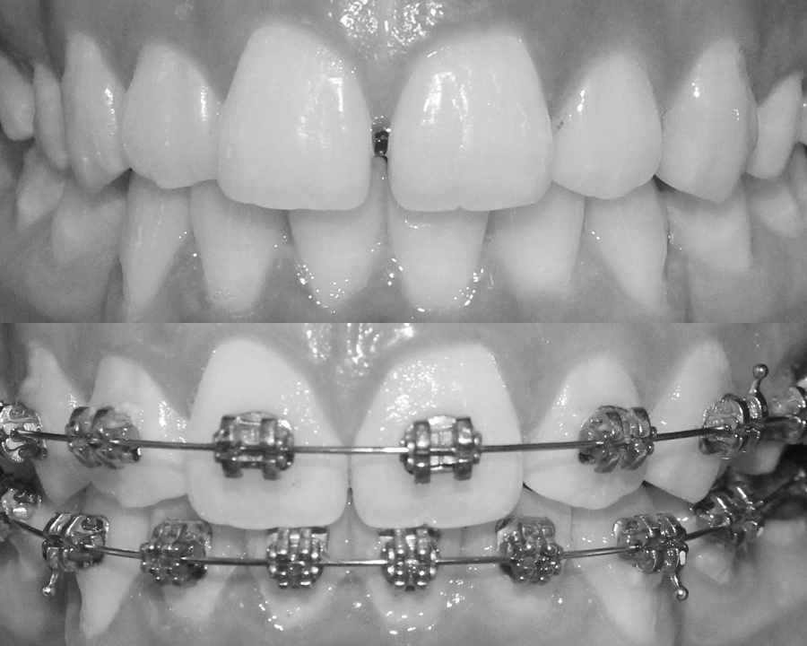 Trên: răng thưa trước điều trị. Dưới: đang đeo niềng răng.