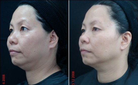 Hình ảnh trước và sau khi điều trị Thermage.