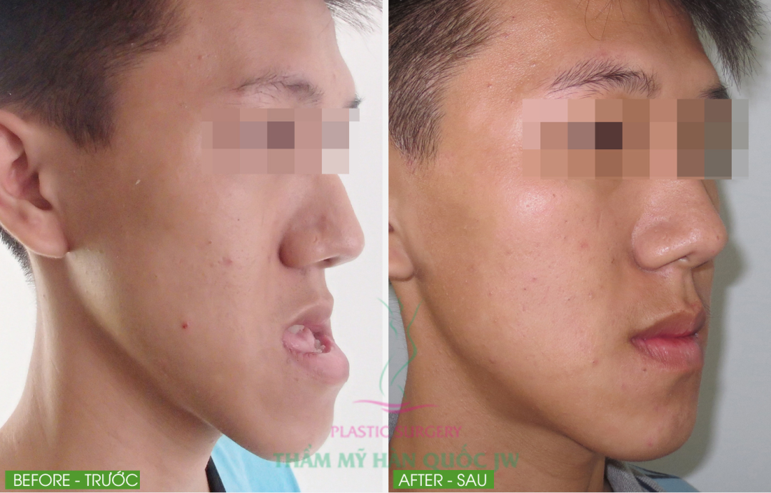 Và Trần Lữ Anh Khoa là một trong những minh chứng điển hình nhất cho thành công của công nghệ phẫu thuật tạo hình hàm móm tại Viện Thẩm mỹ Hàn Quốc JW – sau nhiều năm không khép được miệng, giờ đây Anh Khoa lấy lại sự tự tin trong cuộc sống. Xem thêm tại link: http://thammyhanquoc.vn/tin-tu-tham-my-han-quoc/cau-chuyen-khach-hang.html