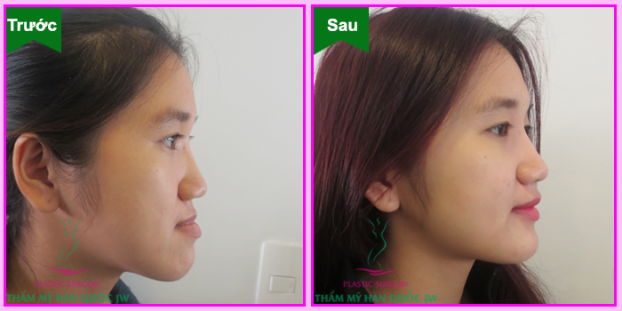 Hình ảnh  khách hàng nữ đã phẫu thuật hàm móm thành công tại Viện Thẩm mỹ Hàn Quốc JW