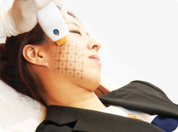 Săn da mặt không phẫu thuật bằng Thermage Total Tip.