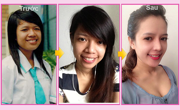 Nguyễn Thị Minh Yến xinh như hot girl sau phẫu thuật thẩm mỹ.