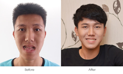 Trần Lữ Anh Khoa “lột xác” thành hot boy sau khi tạm biệt chiếc cằm dị hình