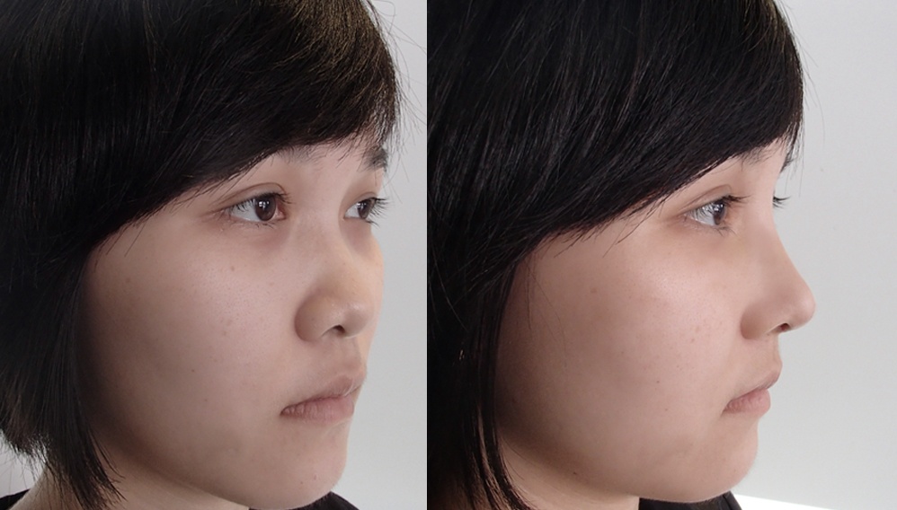 Nâng mũi S-line đúng cách giúp bạn có chiếc mũi thon gọn, thanh mảnh và hợp với khuôn mặt.