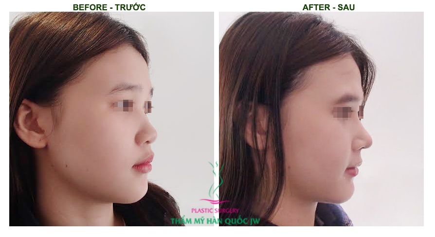 Nâng mũi S-line là một kỹ thuật khó, nếu không thực hiện đúng cách sẽ không mang lại kết quả như ý.