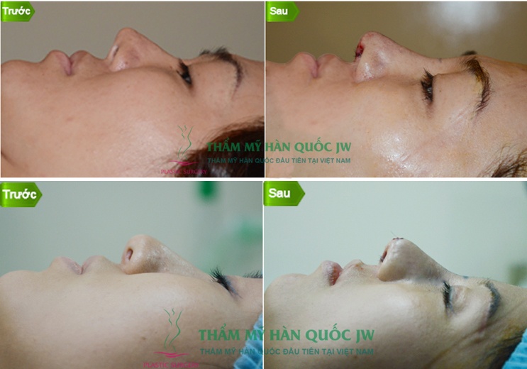 Vài trường hợp phẫu thuật mũi mà TS.BS Man Koon Suh trực tiếp phẫu thuật tại JW Việt Nam trong thời gian 21 -23/4.