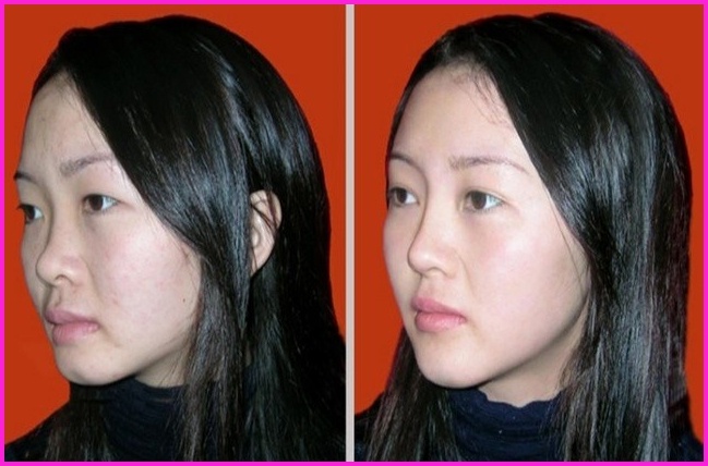 Khách hàng nâng mũi