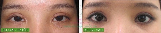 Trong trường hợp không may bị cắt mí hỏng, khiến mí to, giả và hai vết sẹo xấu lộ rõ, có thể nhờ đến kỹ thuật phẫu thuật hiện đại chữa trị cho mắt trở nên to tròn tự nhiên hơn.