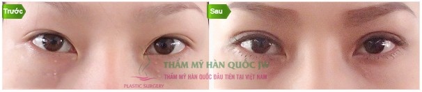 Mắt mí lót và bị xếch sẽ cân đối, hài hóa hơn sau phẫu thuật.