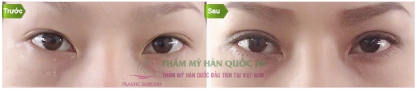 Hình ảnh trước và sau phẫu thuật tạo 2 mí, giảm mắt xếch