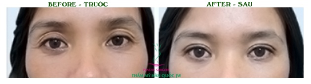 Trường hợp hốc mắt sâu do can thiệp lấy mỡ quá mức, sau khi cấy mỡ và tái tạo lại mí tại Thẩm mỹ viện Hàn Quốc JW, mắt trở nên trẻ trung và sinh động hơn