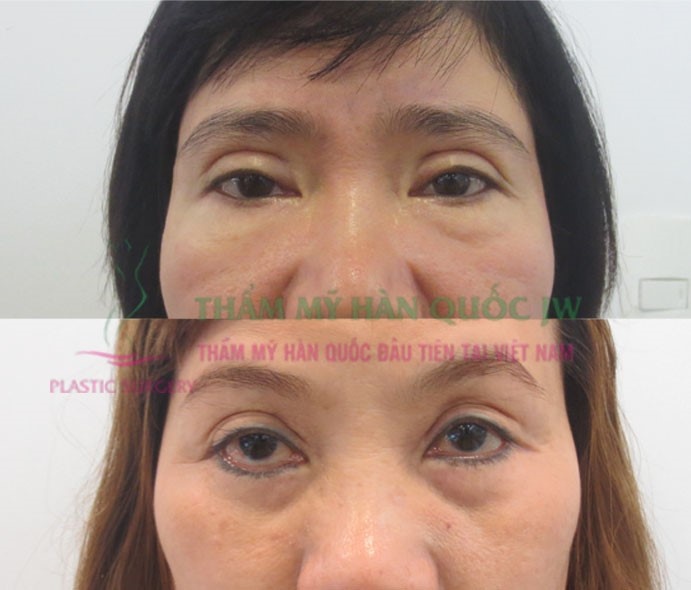 Giờ đây, các lỗi phẫu thuật thẩm mỹ mắt sai đã có thể được khắc phục.