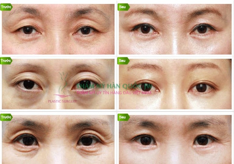 Phẫu thuật trẻ hóa vùng mắt bằng công nghệ mới.