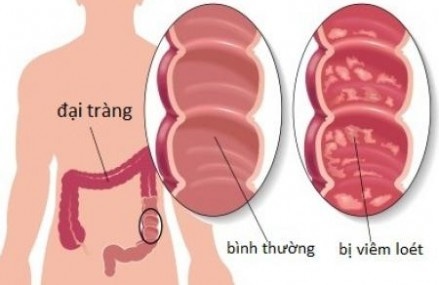 Ly do viem dai trang kho chua dut diem hinh anh