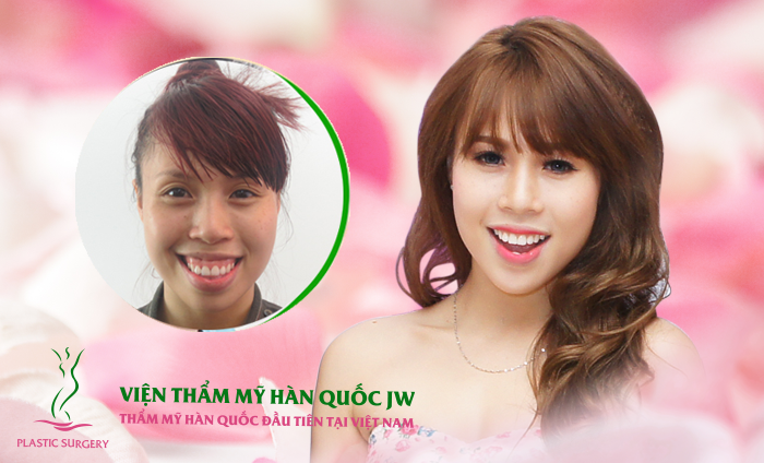 Diễn viên múa Linh Lan  rạng rỡ sau khi thực hiện thành công ca phẫu thuật thẩm mỹ khuôn mặt toàn diện tại Thẩm mỹ Hàn Quốc JW.