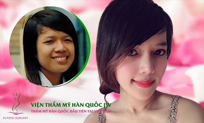 Minh Yến - một trong những ca thẩm mỹ toàn diện khuôn mặt thành công của JW. Cô được bác sĩ phẫu thuật mắt to, phẫu thuật hàm hô, gọt mặt, nâng mũi S-line, lấy túi mỡ má.