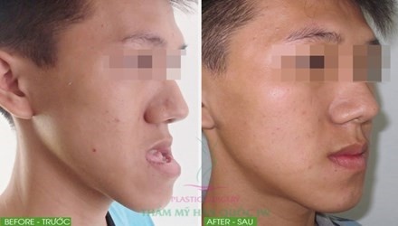 Khuyết điểm hàm móm của Anh Khoa đã được khắc phục hoàn toàn với sự trợ giúp của bác sĩ Nguyễn Phan Tú Dung.