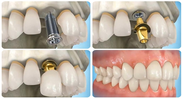 Implant - phuong phap cay ghep rang gia hien dai hinh anh