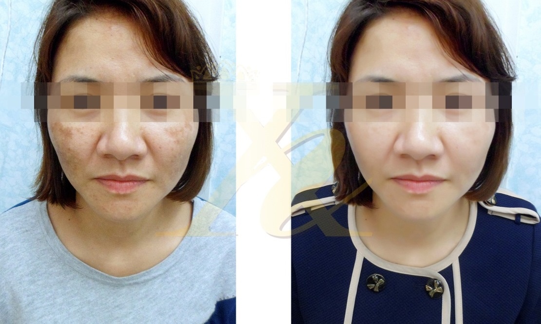 Da hết nám, trắng mịn hồng hào sau điều trị nám bằng laser tại Thẩm mỹ viện Xuân Hương.
