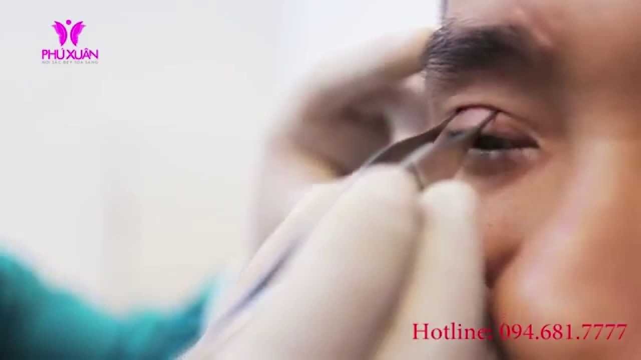 Bác sĩ tư vấn và thăm khám trước khi thực hiện tại Phú Xuân.