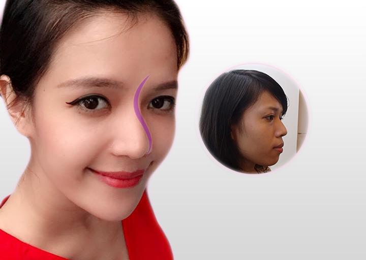 Cận cảnh gương mặt đã qua nâng mũi S-line.