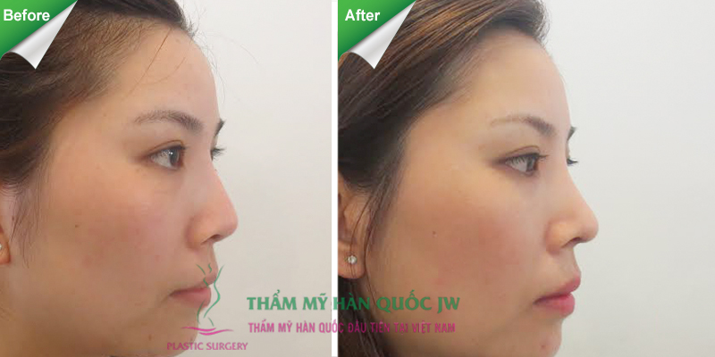 Trước và sau khi nâng mũi.