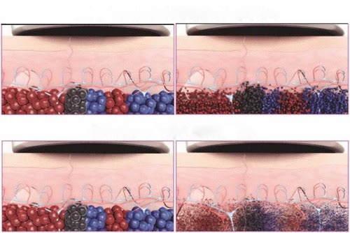 Laser Pico (PicoSure và PicoWay) phân hủy sắc tố thành những mảnh cực nhỏ (nhỏ hơn laser thông thường) nên giúp cơ thể đào thải nhanh chóng và dễ dàng hơn.