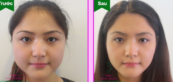 Sau phẫu thuật gọt xương hàm, lấy túi mỡ má tại Thẩm mỹ Hàn Quốc JW bạn gái đã có được khuôn mặt V-line trái xoan thon gọn tự nhiên.