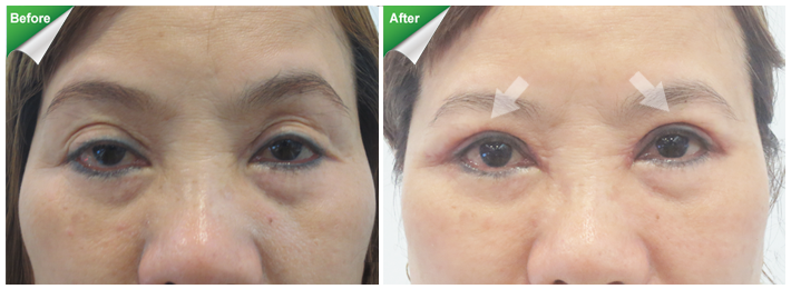 Một tường hợp mắt từng phẫu thuật nhưng mí quá to, trợn, trông lờ đờ, mệt mỏi.