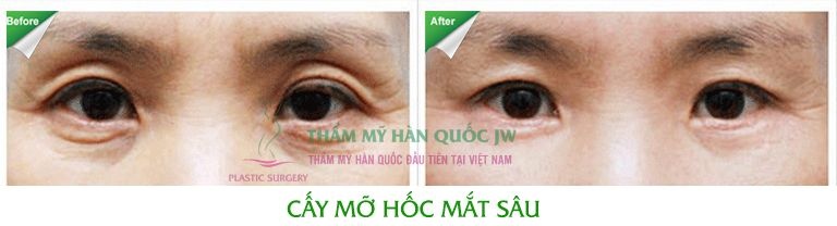 Đây là trường hợp người có hốc mắt bị lõm sâu do thiếu tổ chức mỡ, vùng da mắt nhăn nheo, chảy xệ. Sau khi được cấy mỡ và loại bỏ da thừa, mắt trở nên to hơn, trẻ hơn.