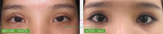 Sau khi phẫu thuật chỉnh sửa, mắt của Mỹ Ngọc bị trợn, thiếu tự nhiên (bên trái). Nhờ chỉnh sửa lại, mắt đã to tròn hơn, hai mí cân đối và hài hòa với khuôn mặt (bên phải).