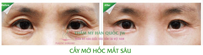 Nguyệt Lê có hốc mắt bị lõm sâu do thiếu tổ chức mỡ, vùng da mắt nhăn nheo, chảy xệ. Sau khi được cấy mỡ và tạo hình mí lại, mắt cô trở nên trẻ trung hơn.