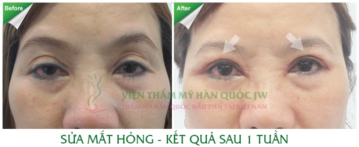 Nguyễn Thị Duyên có mắt bị trợn, mí mắt to, không đều. Sau khi phẫu thuật, đường mí được chỉnh sửa hài hòa, tự nhiên hơn.