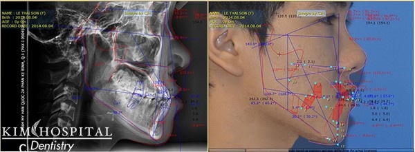Phần mềm phân tích niềng răng hô Vceph đưa ra kết quả niềng răng trước khi bước vào giai đoạn gắn mắc cài hoặc invisalign..