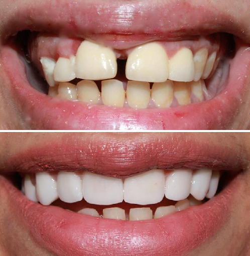 thẩm mỹ, răng sứ ảnh 2 tham my, rang su anh 2