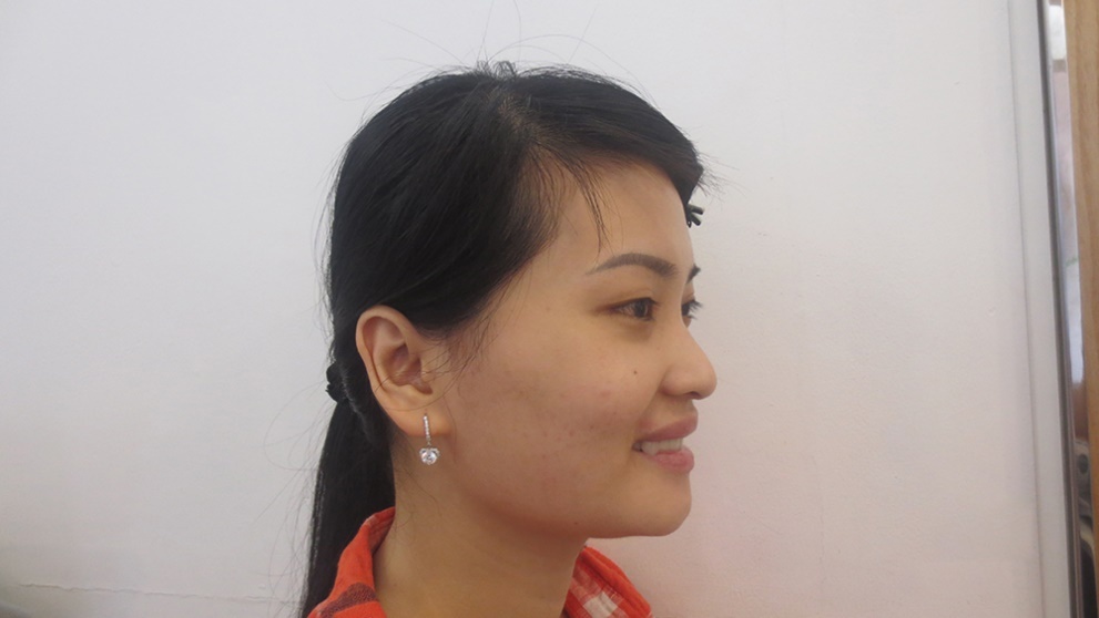 phẫu thuật hàm móm ảnh 2 phau thuat ham mom anh 2