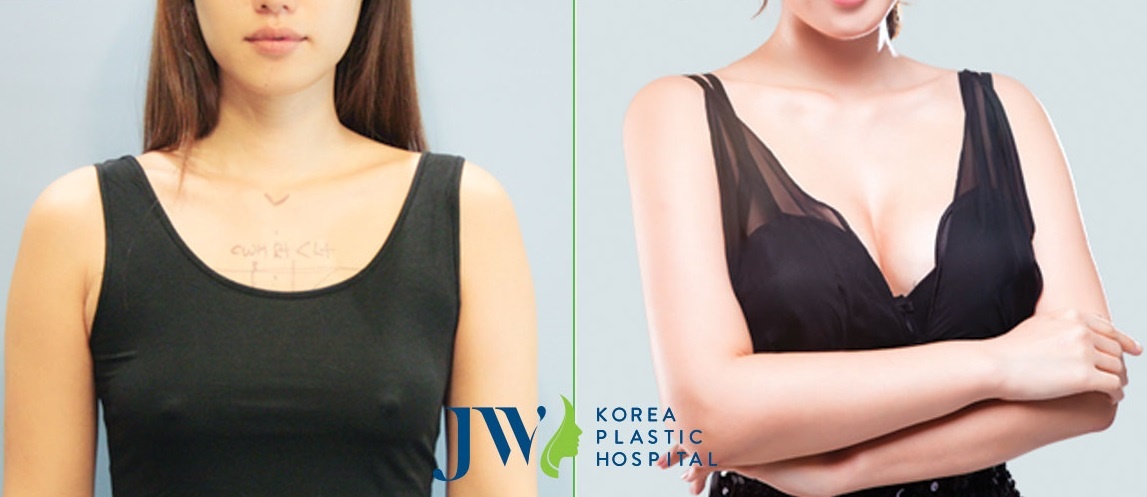 thẩm mỹ,  nâng ngực,  biến chứng ảnh 2 tham my,  nang nguc,  bien chung anh 2