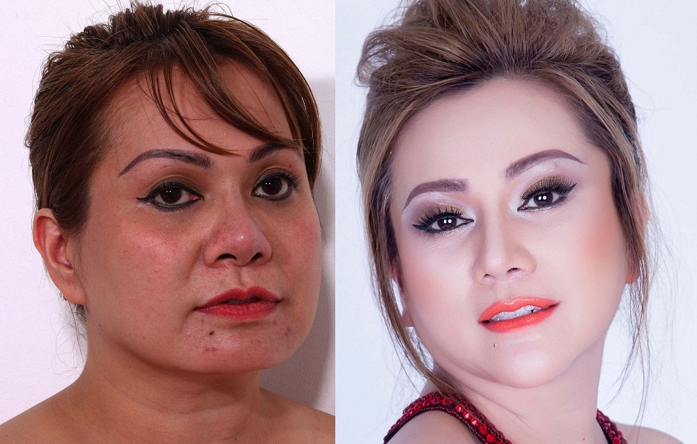 trẻ ra 10 tuổi nhờ phẫu thuật thẩm mỹ ảnh 1 tre ra 10 tuoi nho phau thuat tham my anh 1