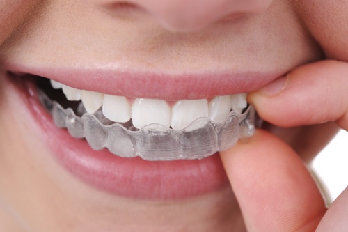Invisalign: Cong nghe nieng rang moi khong gay mat tu tin hinh anh