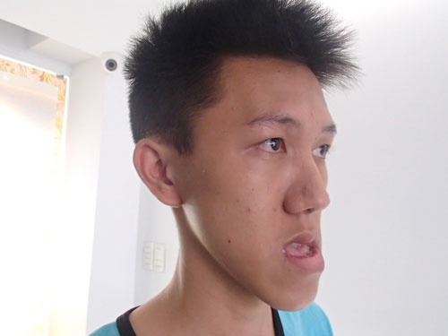 phau thuat ho mom anh 1