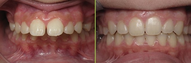 niềng răng,  phẫu thuật chỉnh răng ảnh 1 nieng rang,  phau thuat chinh rang anh 1